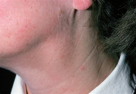 HL is often marked by the swelling of cervical <b>lymph</b> <b>nodes</b>. . Can shingles cause swollen lymph nodes in neck